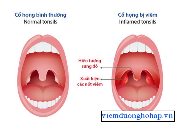 Cách phân biệt cổ họng bình thường và khi mắc viêm họng hạt