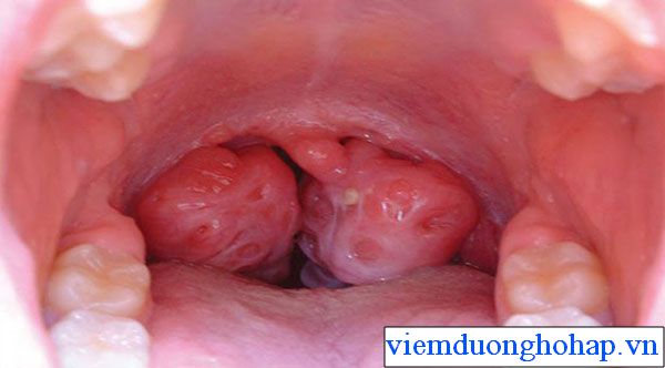 Ung thu vòm họng là biến chứng nguy hiểm nhất của viêm họng hạt