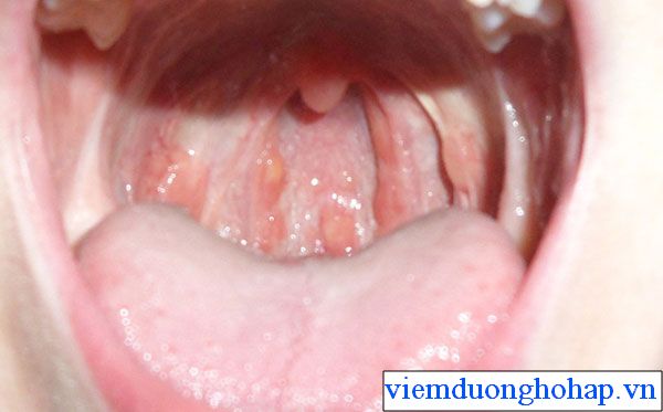 Cổ họng nổi hạt -Dấu hiệu bệnh viêm họng hạt