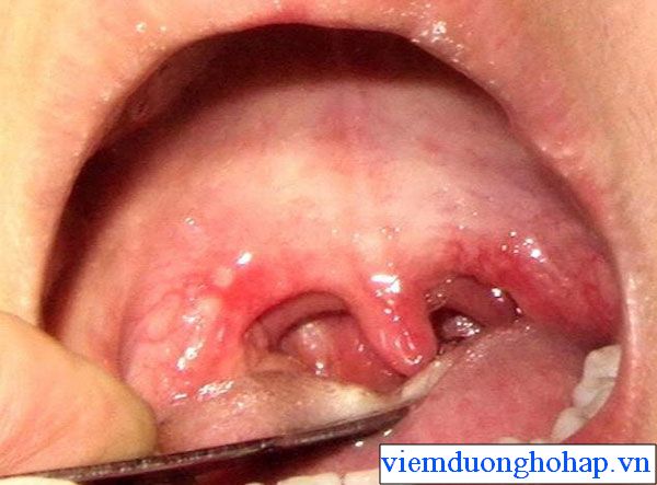 Sùi vòm họng có thể dẫn đến ung thu vòm họng nguy hiểm