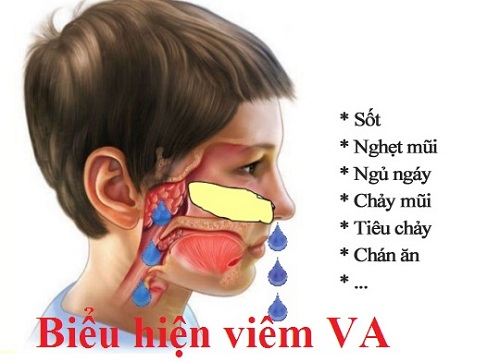 biểu hiện viêm VA ở trẻ