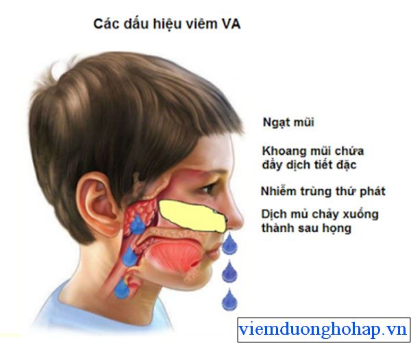 Các triệu chứng của bệnh viêm VA ở trẻ