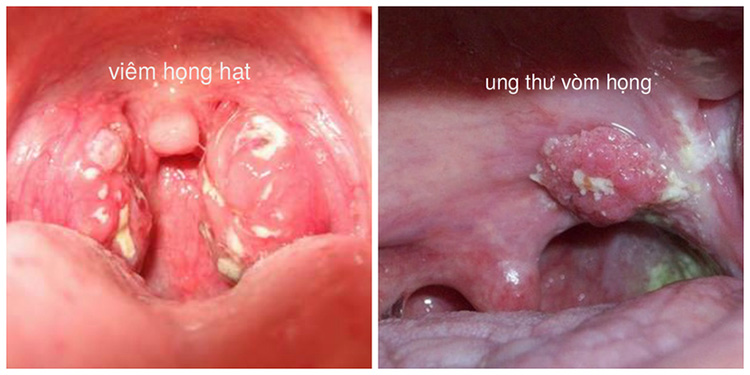 Sự khác nhau giữa viêm họng hạt và ung thư vòm họng 1