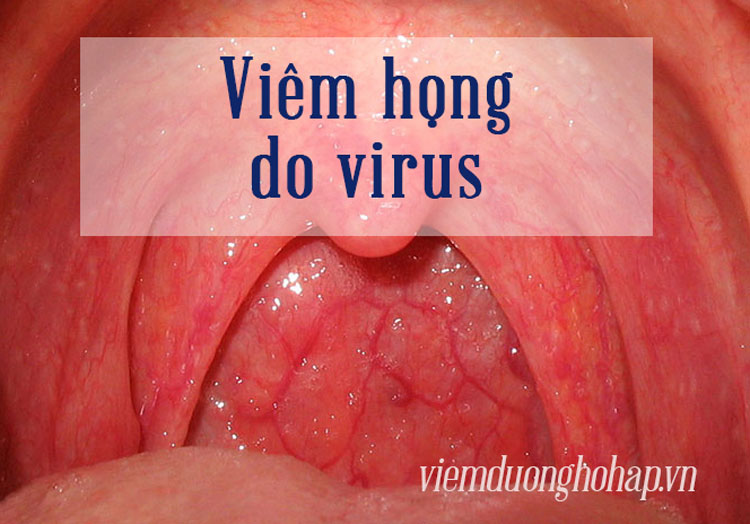 Viêm họng do virus là gì? 1