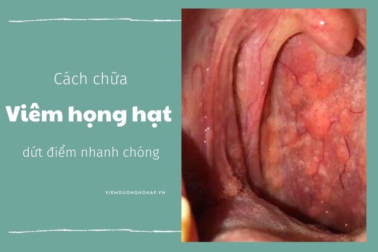 Các cách chữa viêm họng hạt dứt điểm nhanh chóng