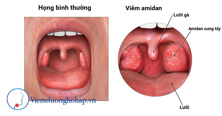 Cắt amidan là gì?[caption id= Cắt amidan là gì?[caption id=