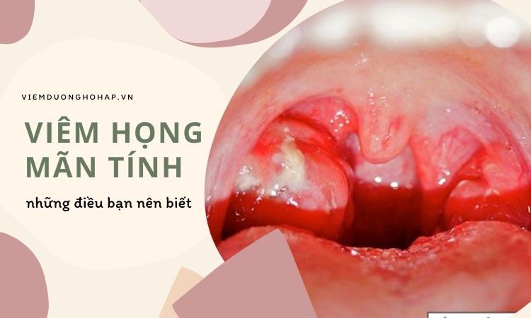 Viêm họng mãn tính nguyên nhân đến điều trị!