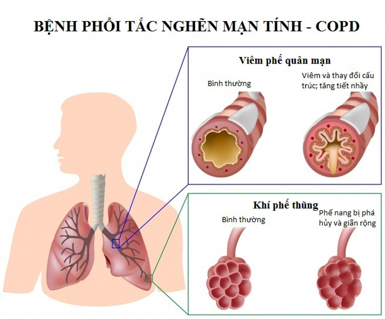 Bệnh phổi tắc nghẽn mãn tính (COPD) 1